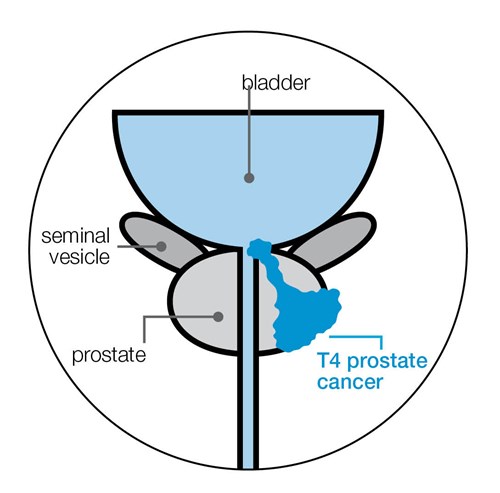 t4-stage-prostate-cancer